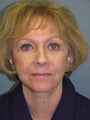  74 y/o Lite Lift  / Face Lift
