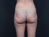Liposuction Inner & Outer Thighs