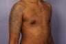 Male Breast Reduction