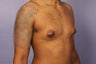 Male Breast Reduction