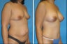 Mommy Makeover: Tummy tuck with breast augmentation