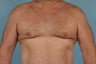 Male Breast Reduction