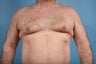 Male Breast Reduction