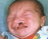 Infant who underwent surgery for a cleft lip and palate 