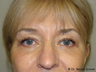Eyelid Surgery