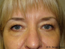 Eyelid Surgery