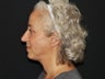 Facelift