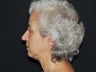 Facelift