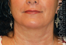 Neck Lift