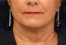 Neck Lift