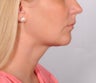 Neck lift for a young woman