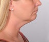 Neck lift for a young woman