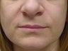 Juvederm before and after