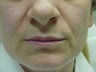 Juvederm before and after