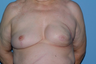 70-year-old Breast Reconstruction patient had bilateral reconstruction 