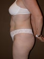 Tummy Tuck
