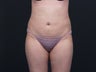 Liposuction Abdomen, Flanks, Inner & Outer Thighs