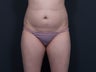 Liposuction Abdomen, Flanks, Inner & Outer Thighs