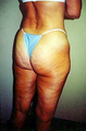 Liposuction