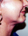 Neck Lift