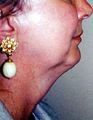 Neck Lift