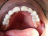 33 year old patient treated for 3 unit bridges