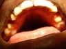 33 year old patient treated for 3 unit bridges