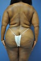 Brazilian Buttock Lift