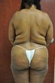 Brazilian Buttock Lift