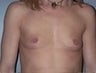 29 year old female patient who underwent a breast augmentation with breast implants 