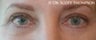 Eyelid Surgery