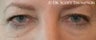 Eyelid Surgery
