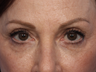 Restylane