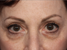Restylane