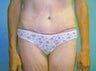 47 year old female patient 