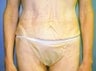 47 year old female patient 