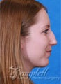 Rhinoplasty
