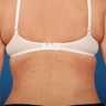 Vaser Liposuction