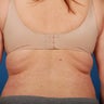 Vaser Liposuction