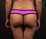Butt Augmentation