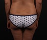 Butt Augmentation