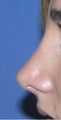 25 y.o. Nose Surgery-Rhinoplasty