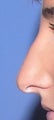 25 y.o. Nose Surgery-Rhinoplasty