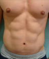 Liposuction