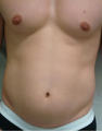 Liposuction