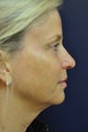Ultherapy