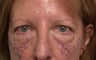 Quad-blepharoplasty