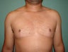 FTM "Top Surgery" Chest Masculinization