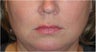 Juvederm
