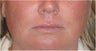 Juvederm